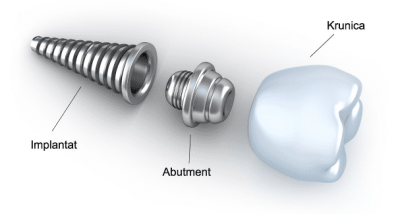 Implantat Implantat